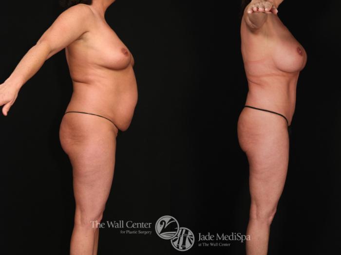 Before & After Tummy Tuck Case 618 View #3 View in Shreveport, LA