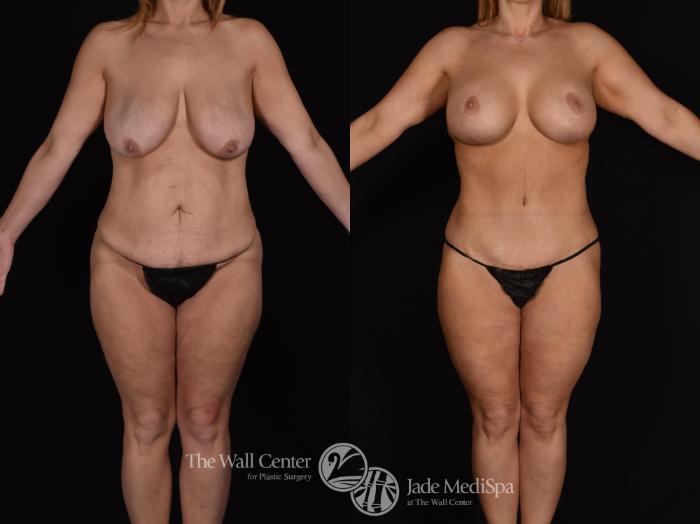 Before & After Tummy Tuck Case 638 VIEW #1 View in Shreveport, LA