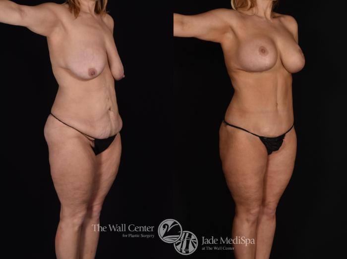 Before & After Tummy Tuck Case 638 VIEW #2 View in Shreveport, LA
