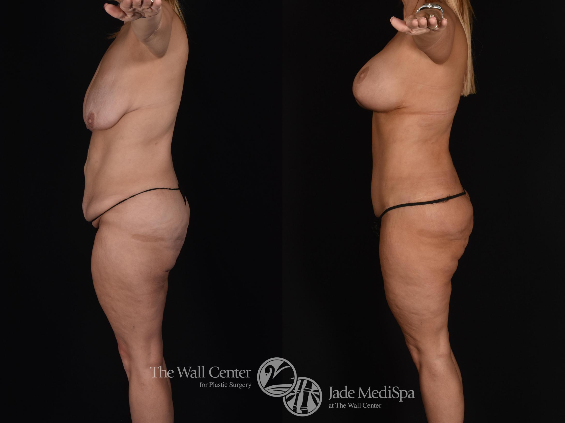 Before & After Tummy Tuck Case 638 VIEW #3 View in Shreveport, LA