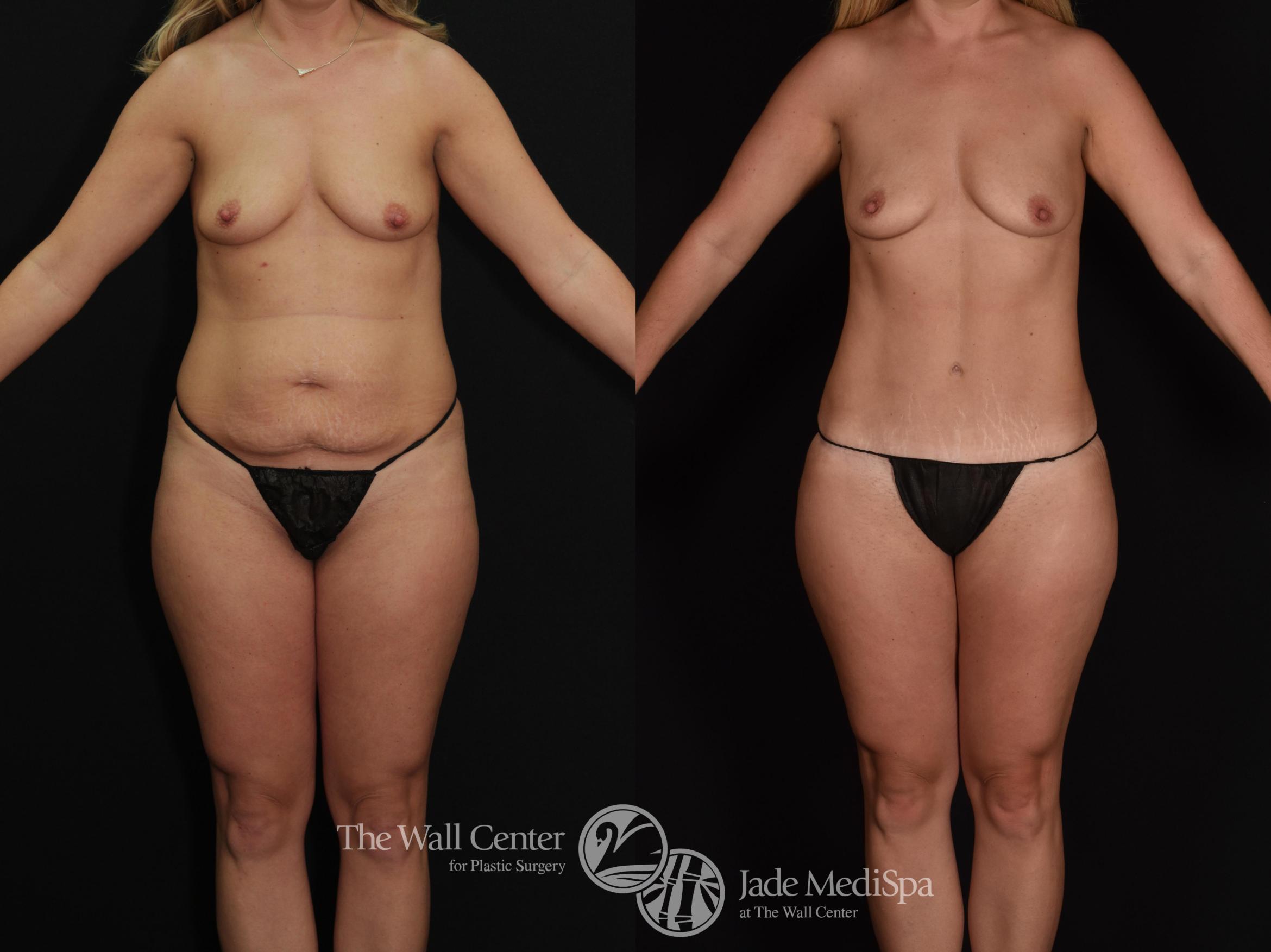 Before & After Tummy Tuck Case 676 VIEW #1 View in Shreveport, LA