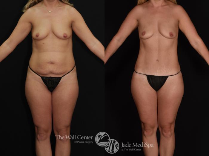 Before & After Tummy Tuck Case 676 VIEW #1 View in Shreveport, LA