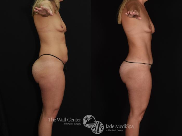 Before & After Tummy Tuck Case 676 VIEW #3 View in Shreveport, LA