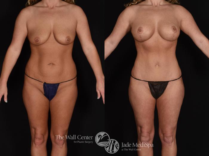 Before & After Tummy Tuck Case 677 VIEW #1 View in Shreveport, LA