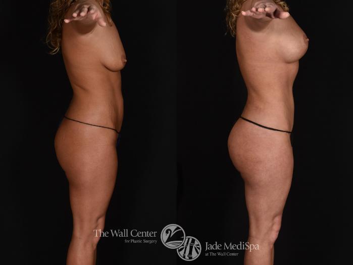 Before & After Buttock Augmentation Case 677 VIEW #3 View in Shreveport, LA