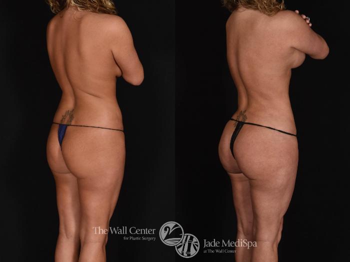 Before & After Tummy Tuck Case 677 VIEW #4 View in Shreveport, LA
