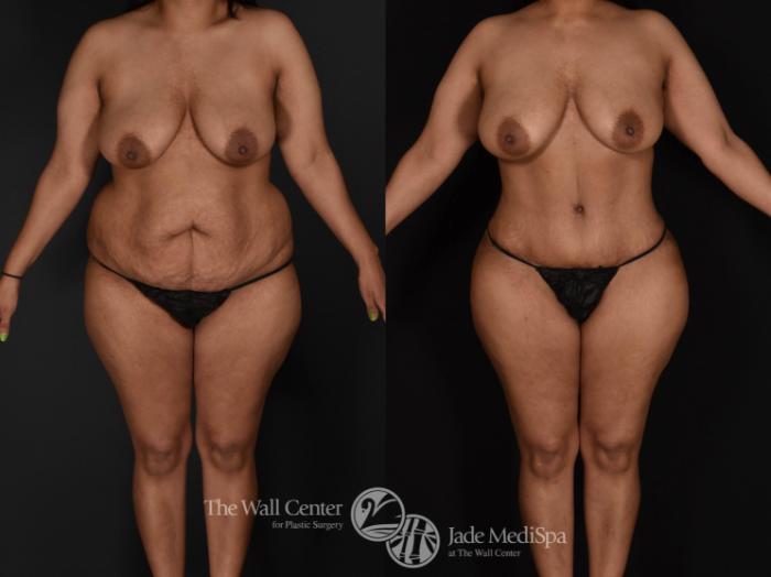 Before & After Tummy Tuck Case 679 VIEW #1 View in Shreveport, LA