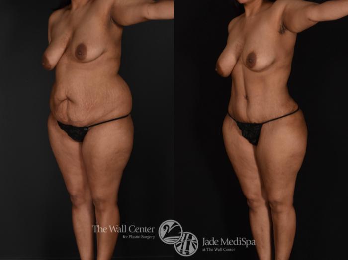 Before & After Tummy Tuck Case 679 VIEW #2 View in Shreveport, LA