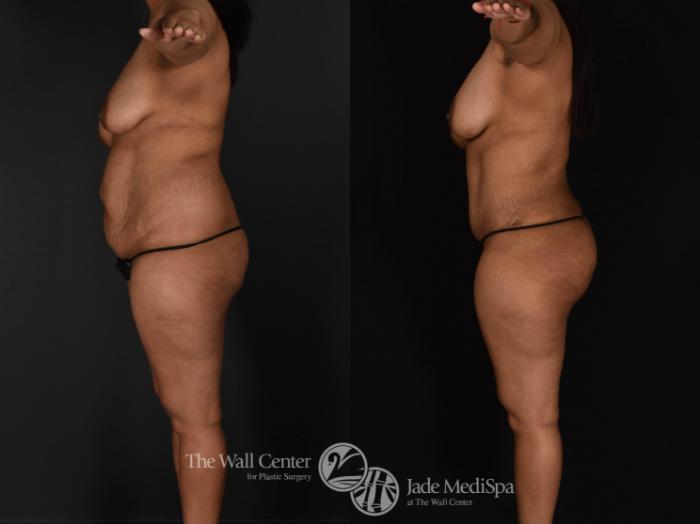 Before & After Tummy Tuck Case 679 VIEW #3 View in Shreveport, LA