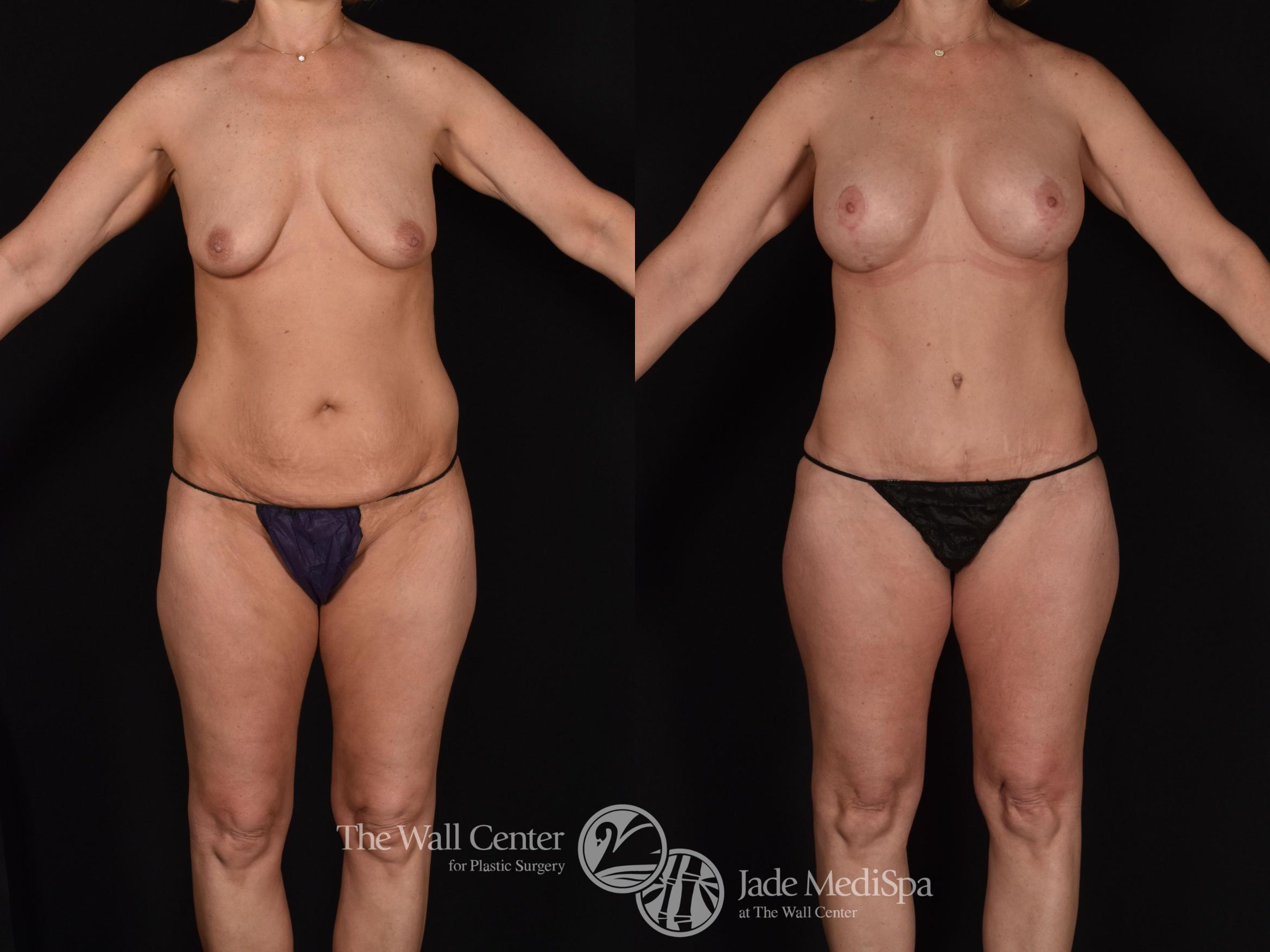 Before & After Tummy Tuck Case 680 VIEW #1 View in Shreveport, LA