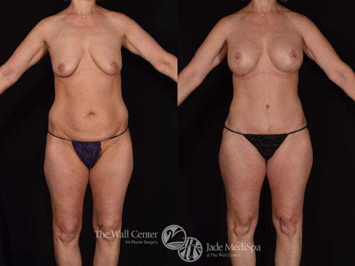 Before & After Tummy Tuck Case 680 VIEW #1 View in Shreveport, LA