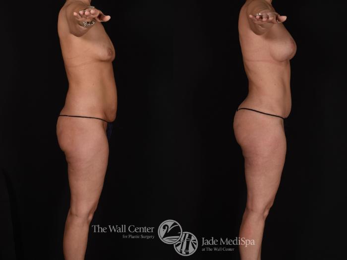 Before & After Tummy Tuck Case 680 VIEW #3 View in Shreveport, LA