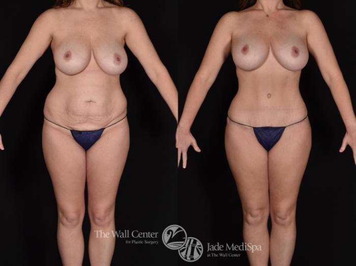 Before & After Tummy Tuck Case 681 VIEW #1 View in Shreveport, LA