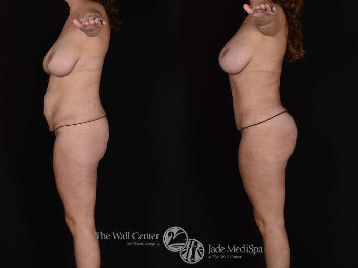 Before & After Fat Grafting – Buttocks Case 681 VIEW #3 View in Shreveport, LA