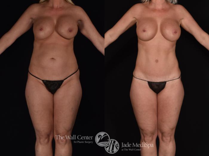 Before & After Tummy Tuck Case 686 VIEW #2 View in Shreveport, LA