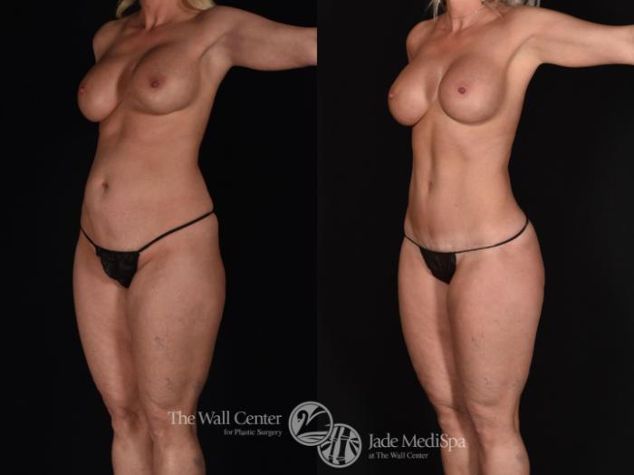 Before & After Tummy Tuck Case 686 VIEW #3 View in Shreveport, LA