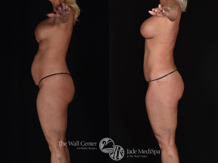 Before & After Tummy Tuck Case 686 VIEW #4 View in Shreveport, LA