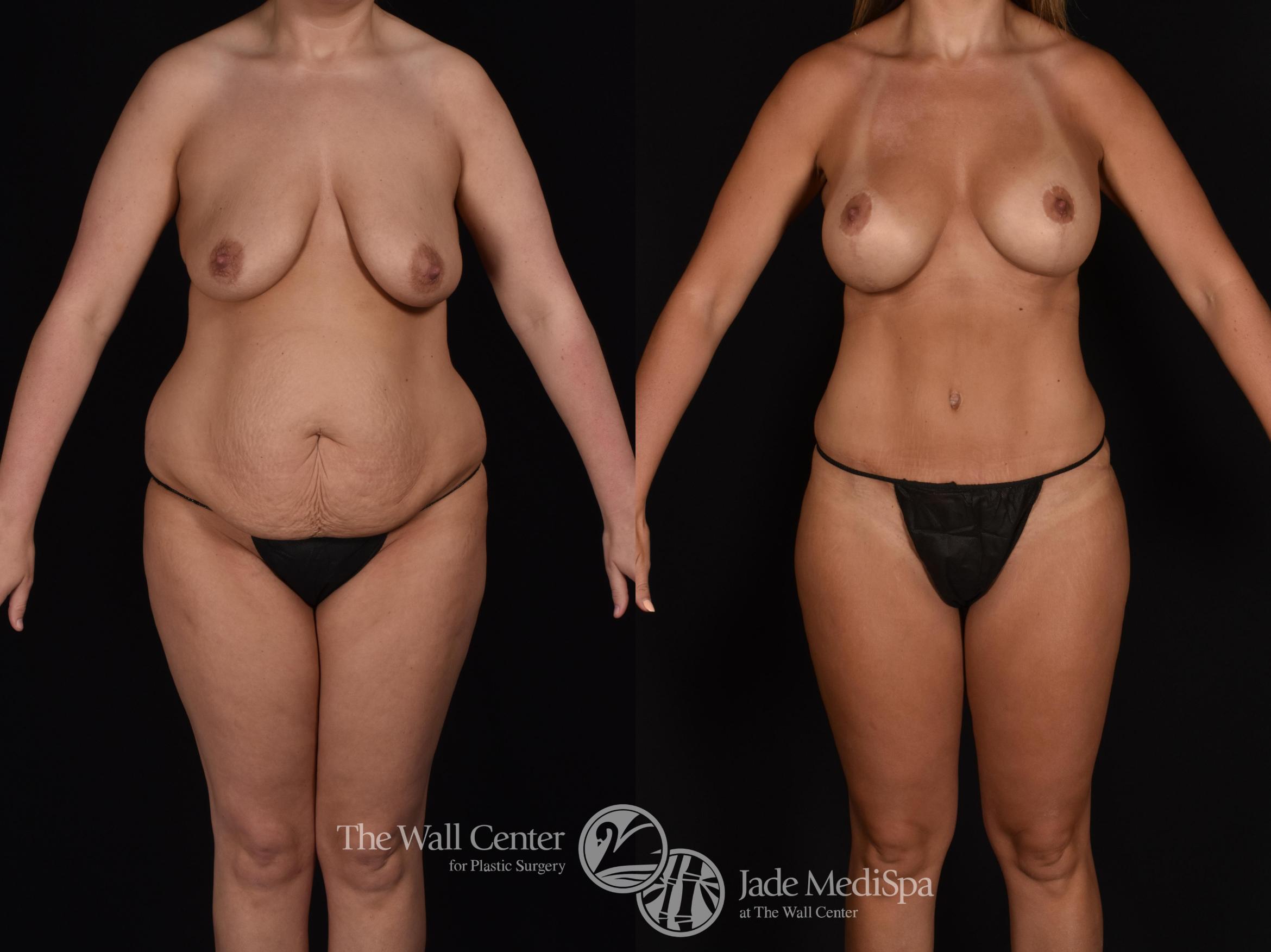 Before & After Tummy Tuck Case 701 VIEW #1 View in Shreveport, LA