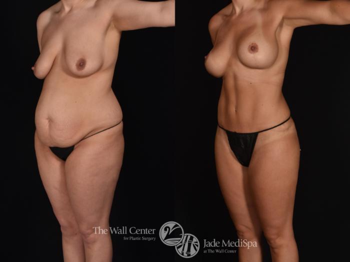 Before & After Tummy Tuck Case 701 VIEW #2 View in Shreveport, LA