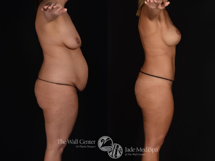 Before & After Tummy Tuck Case 701 VIEW #3 View in Shreveport, LA