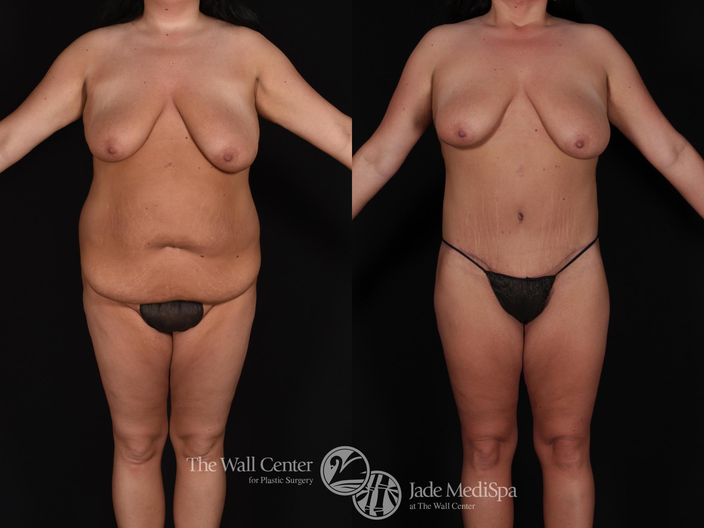 Before & After Tummy Tuck Case 713 VIEW #1 View in Shreveport, LA
