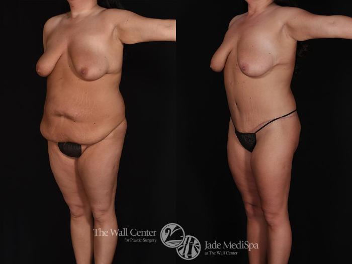 Before & After Tummy Tuck Case 713 VIEW #2 View in Shreveport, LA