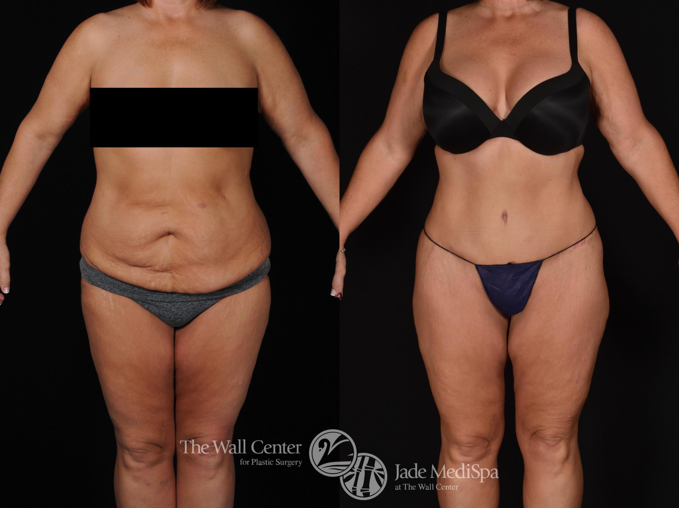 Before & After Tummy Tuck Case 716 VIEW #1 View in Shreveport, LA