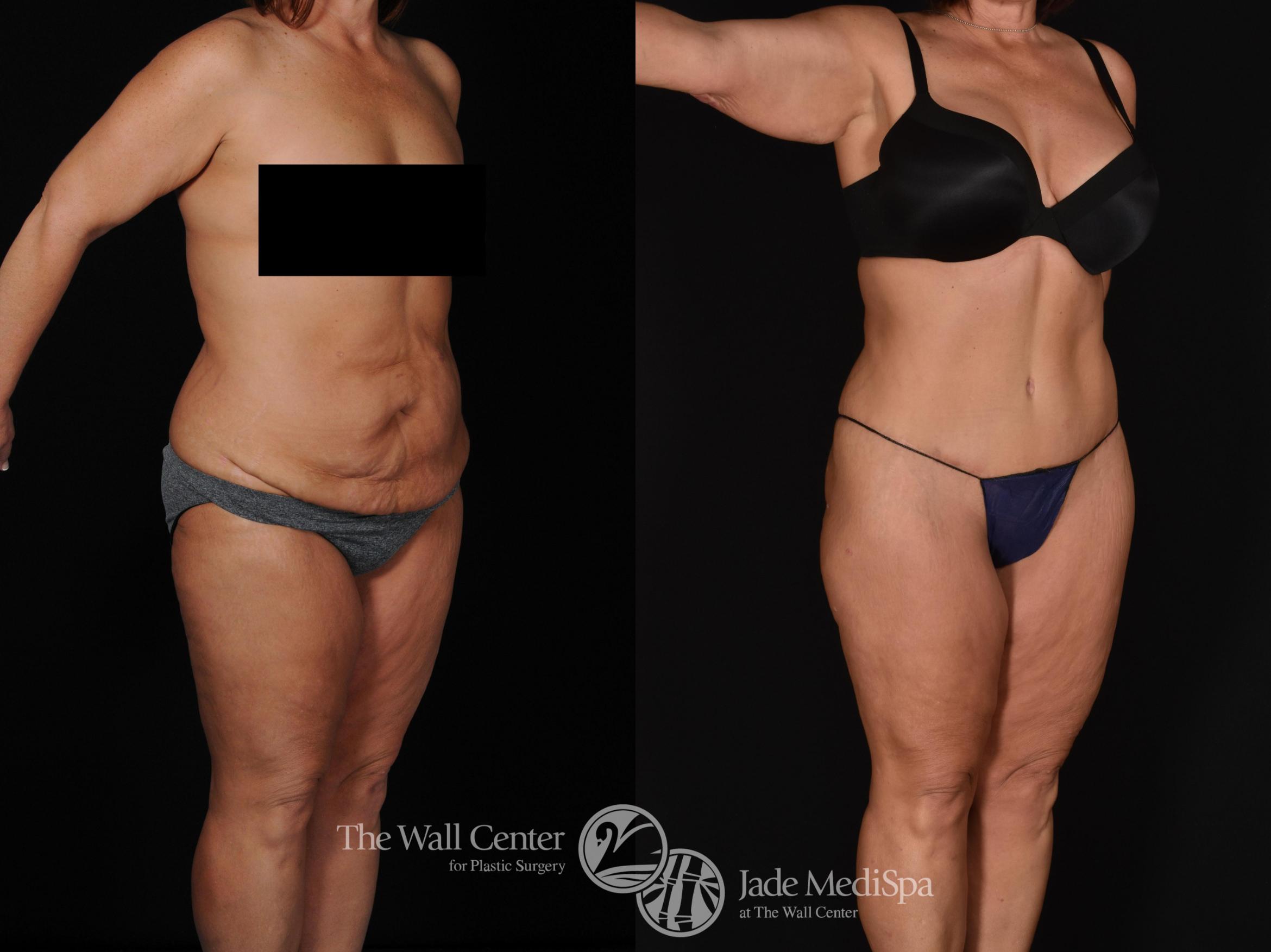 Before & After Tummy Tuck Case 716 VIEW #2 View in Shreveport, LA