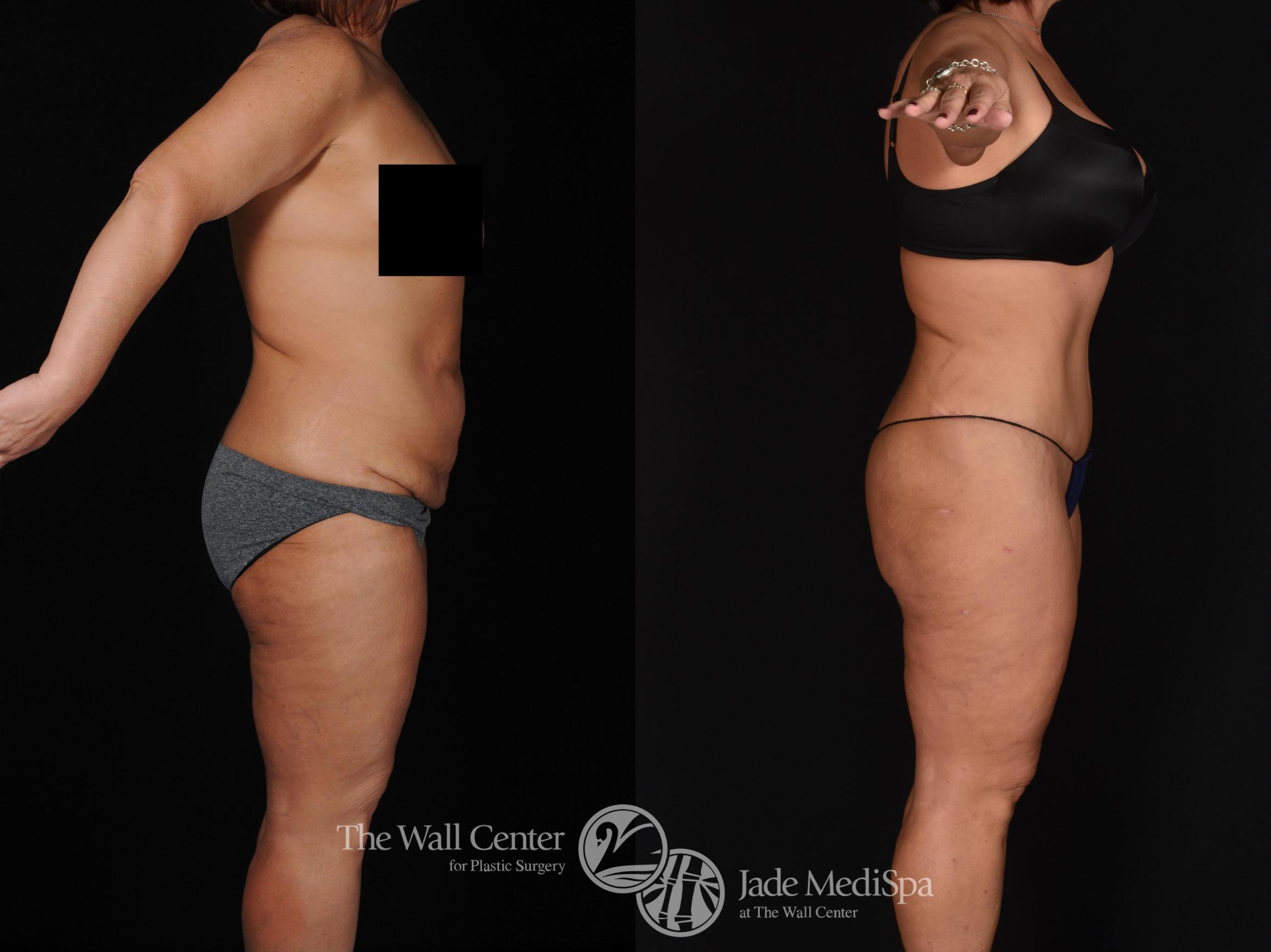 Before & After Tummy Tuck Case 716 VIEW #3 View in Shreveport, LA