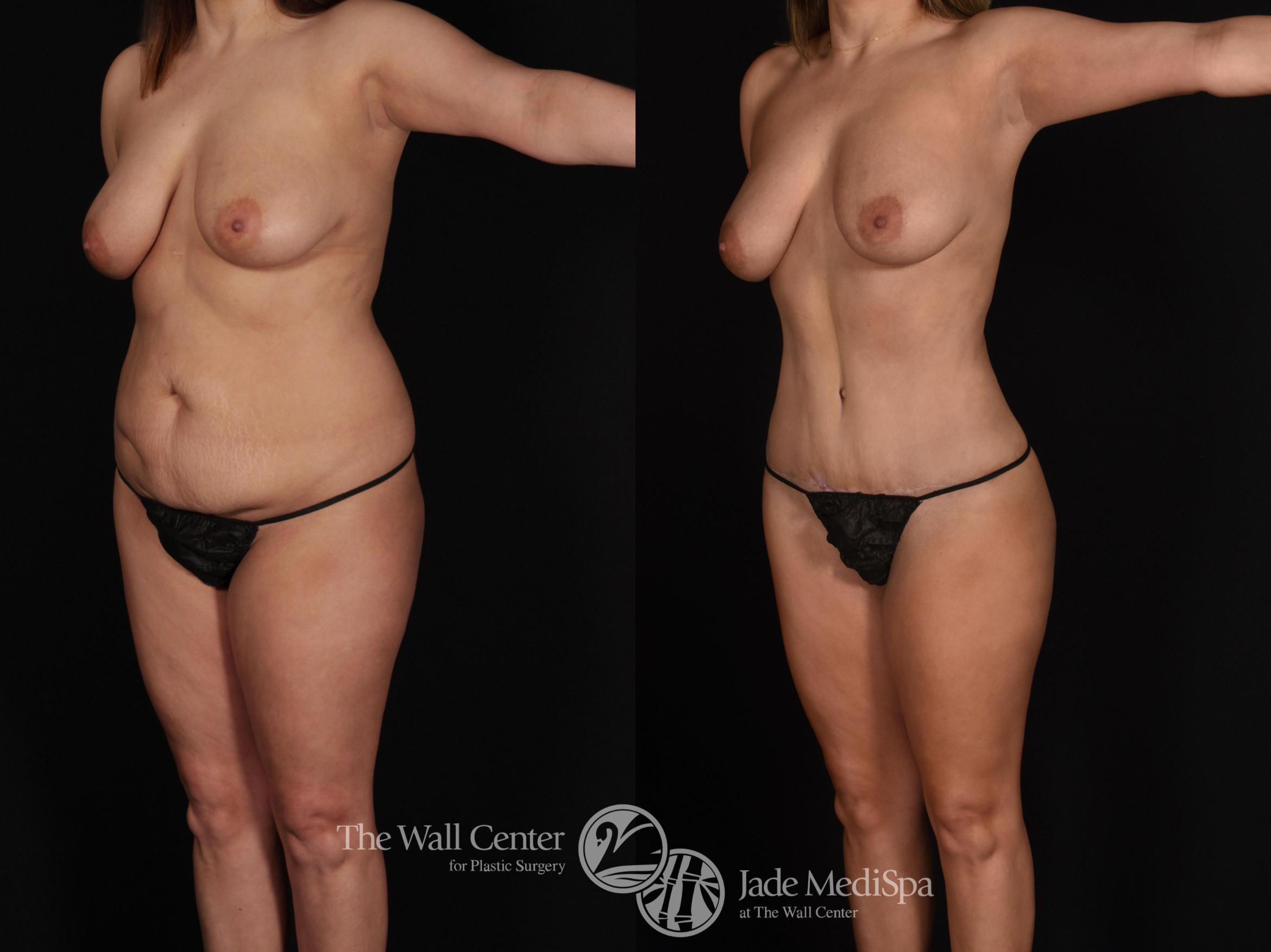 Before & After Tummy Tuck Case 718 VIEW #1 View in Shreveport, LA