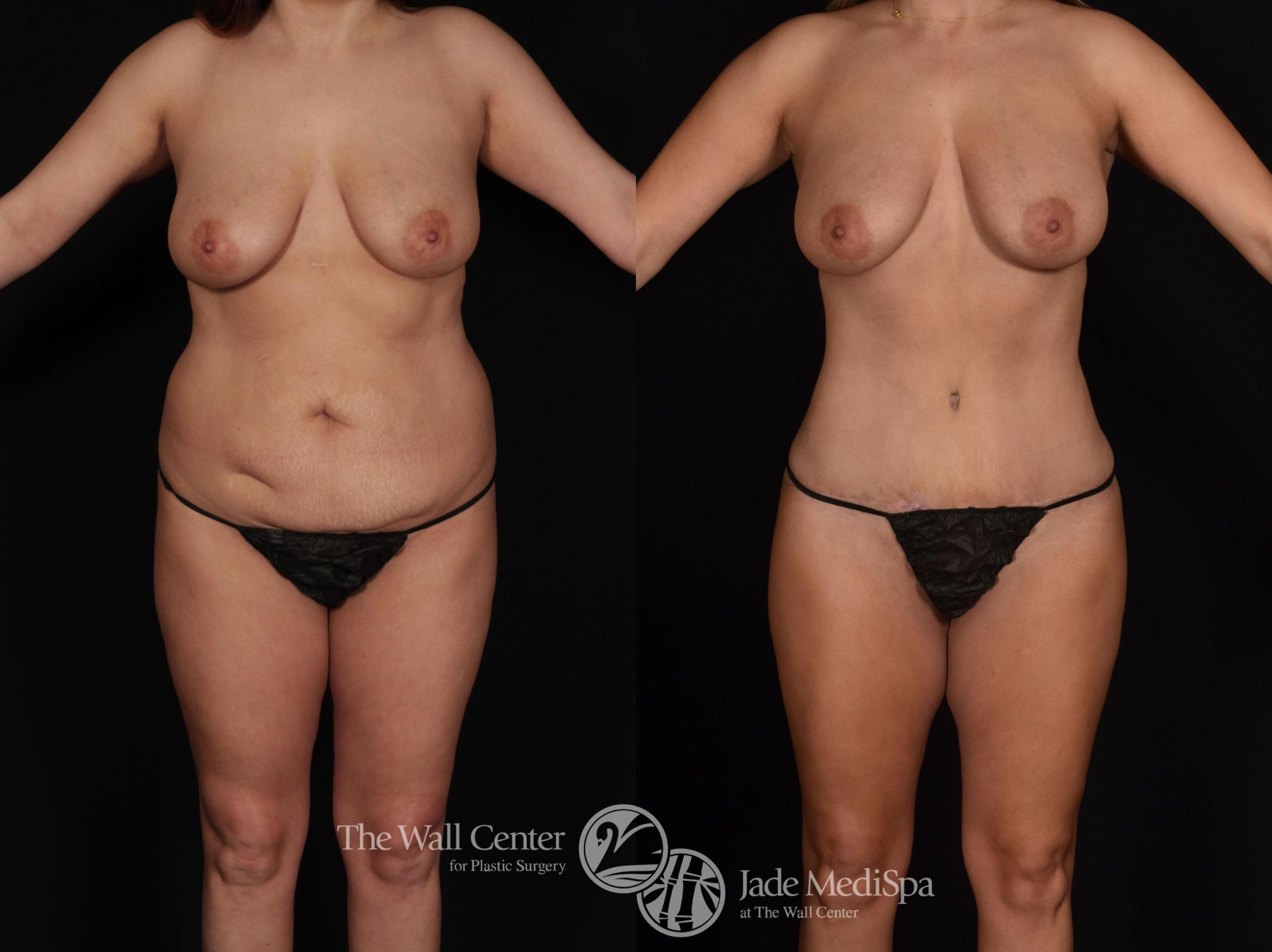 Before & After Tummy Tuck Case 718 VIEW #2 View in Shreveport, LA
