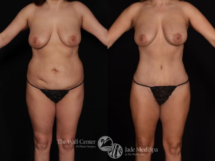 Before & After Fat Grafting – Buttocks Case 718 VIEW #2 View in Shreveport, LA