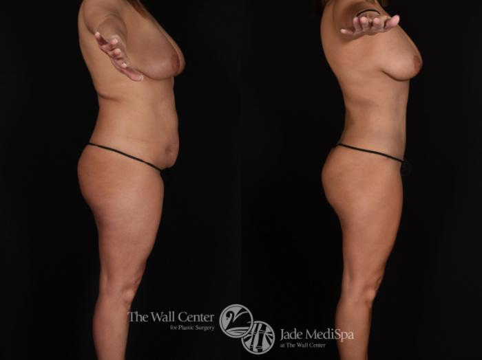 Before & After Fat Grafting – Buttocks Case 718 VIEW #3 View in Shreveport, LA