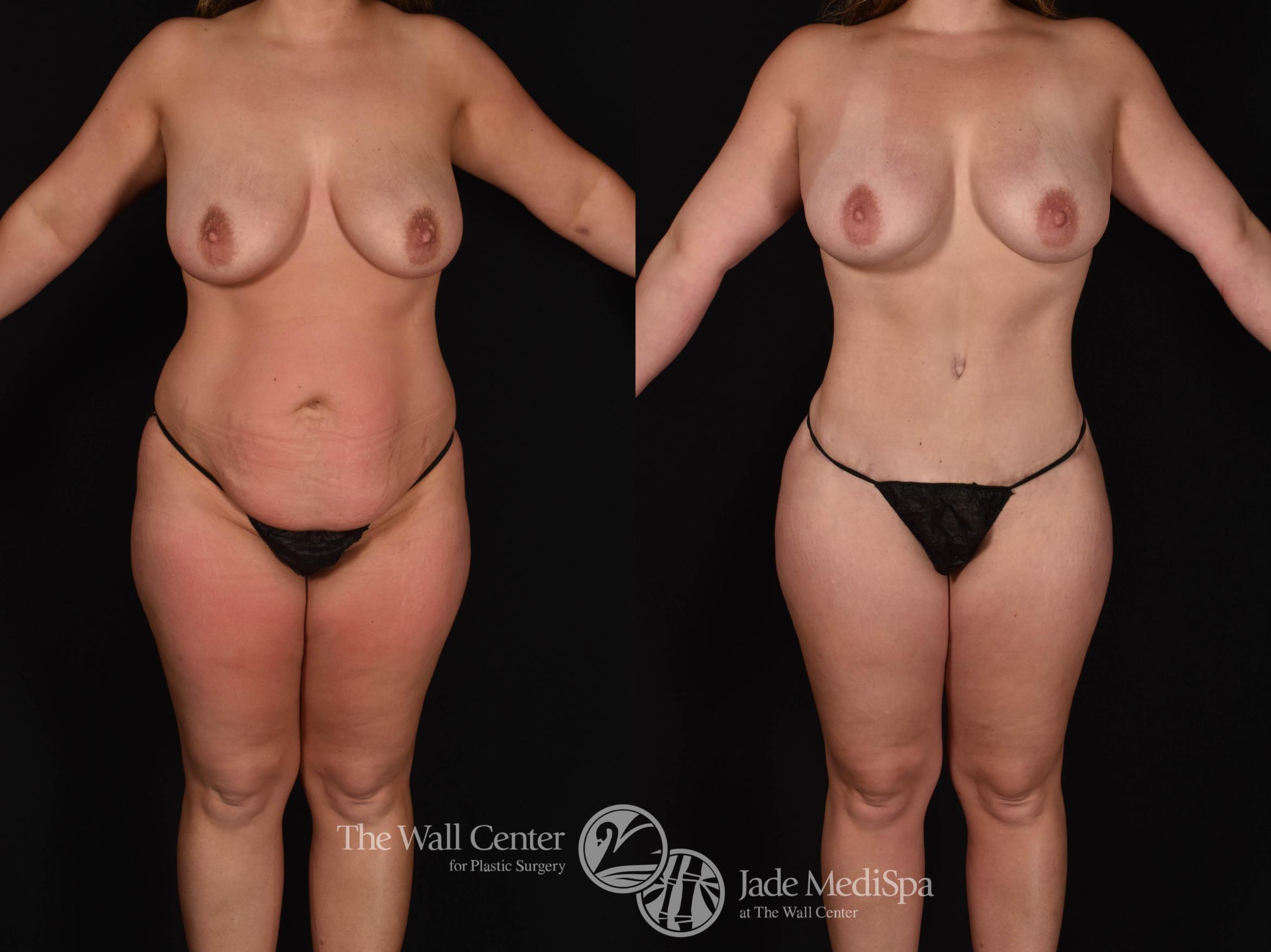 Before & After Fat Grafting – Buttocks Case 780 VIEW #1 View in Shreveport, LA