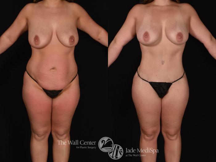 Before & After Buttock Augmentation Case 780 VIEW #1 View in Shreveport, LA