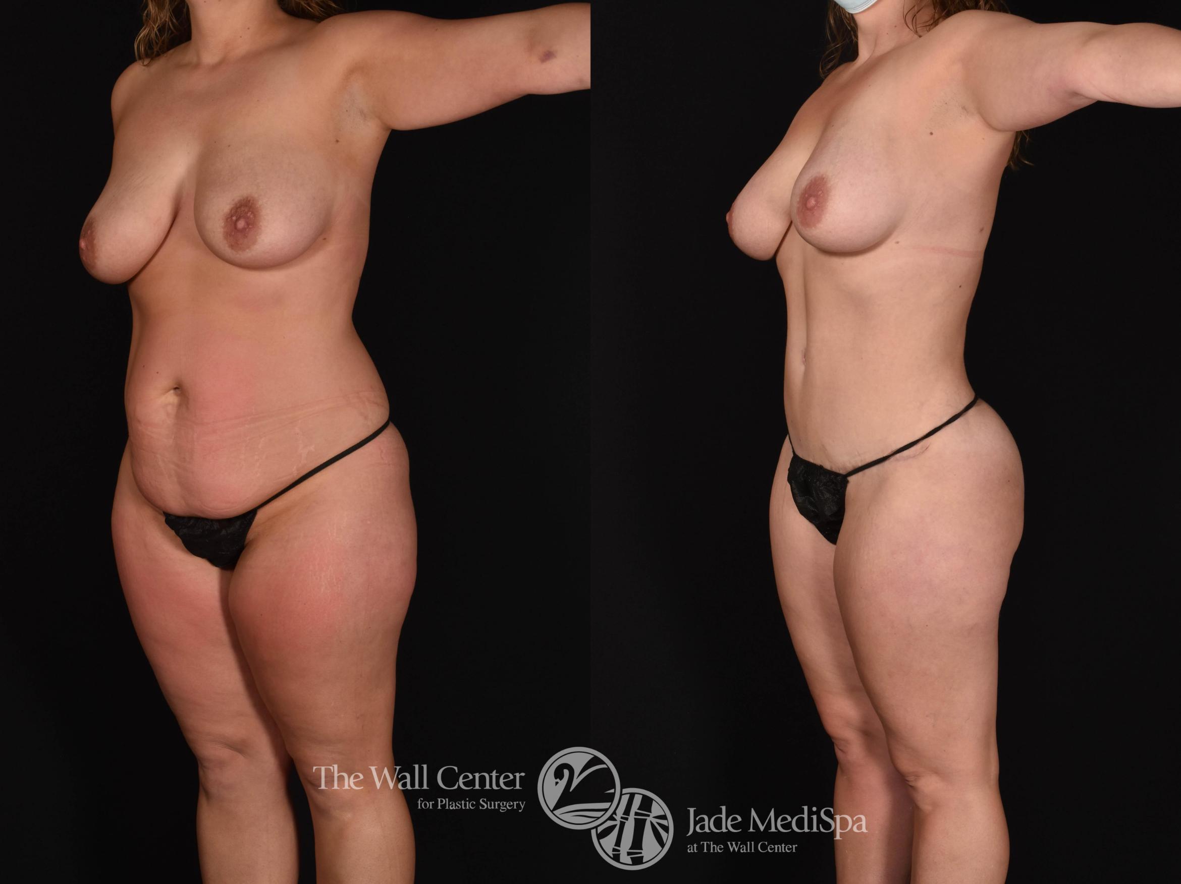 Before & After Buttock Augmentation Case 780 VIEW #2 View in Shreveport, LA