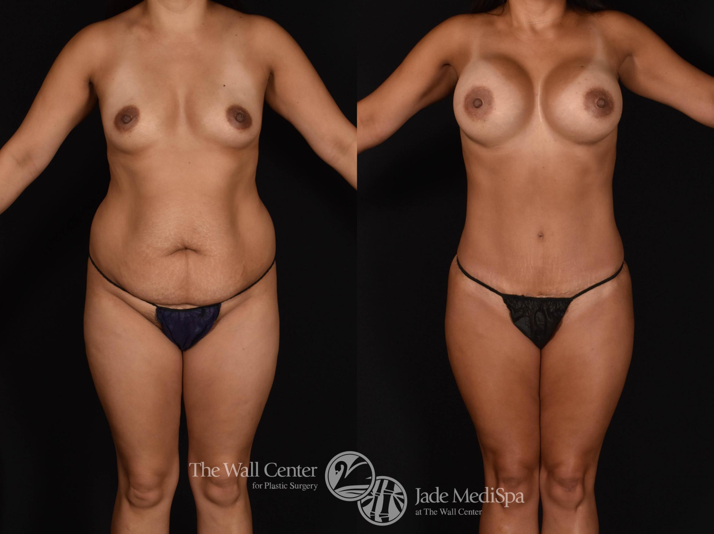 Before & After Buttock Augmentation Case 784 VIEW #1 View in Shreveport, LA