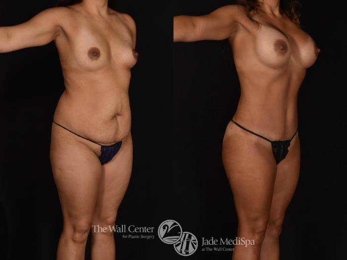 Before & After Buttock Augmentation Case 784 VIEW #2 View in Shreveport, LA
