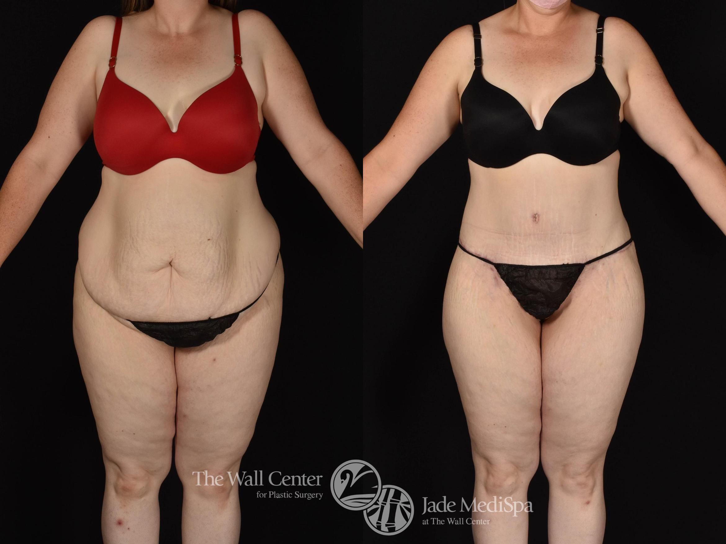 Before & After Tummy Tuck Case 799 VIEW #1 View in Shreveport, LA