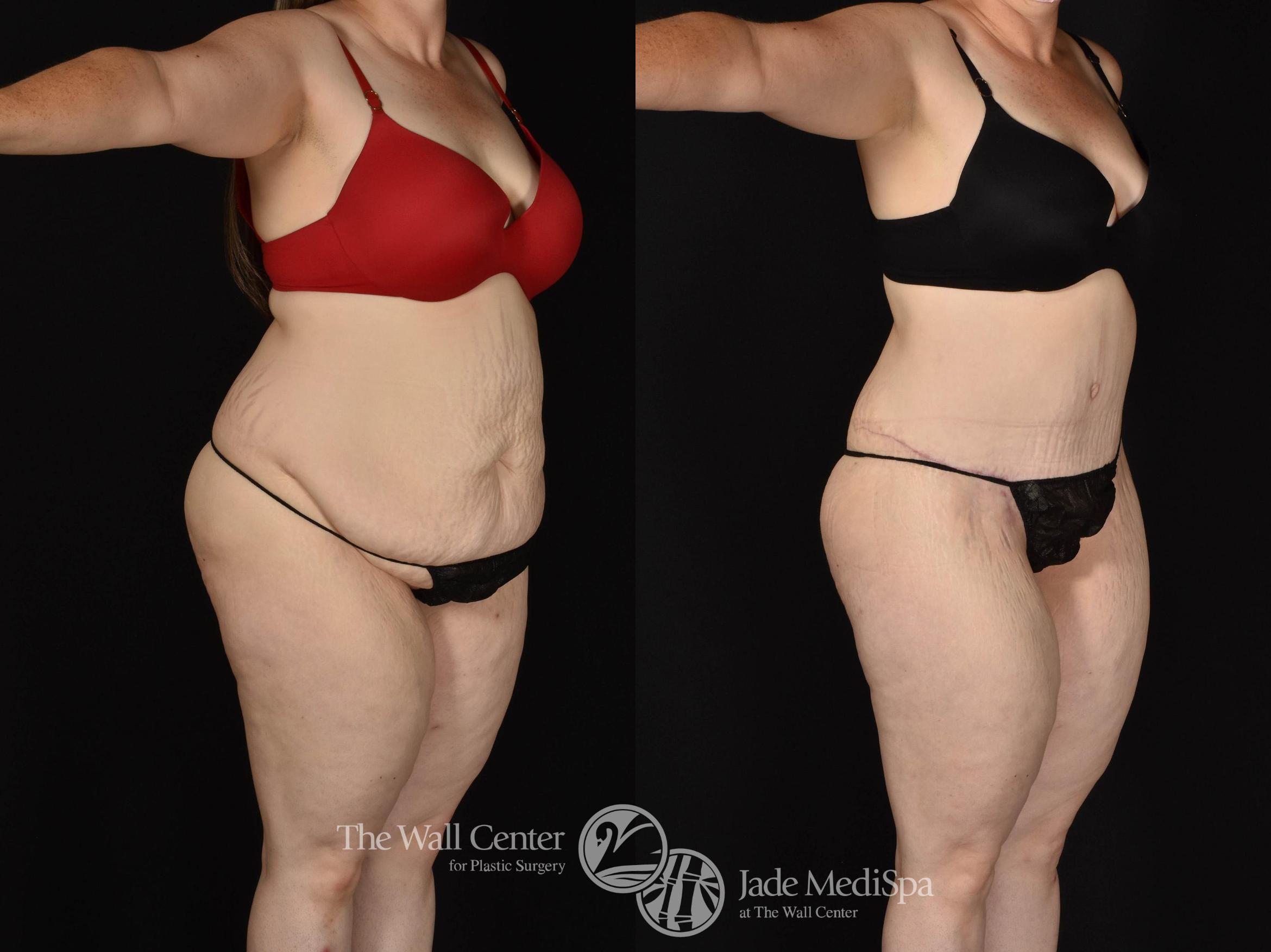 Before & After Tummy Tuck Case 799 VIEW #2 View in Shreveport, LA