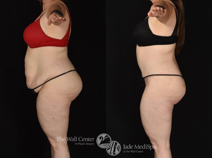 Before & After Tummy Tuck Case 799 VIEW #3 View in Shreveport, LA