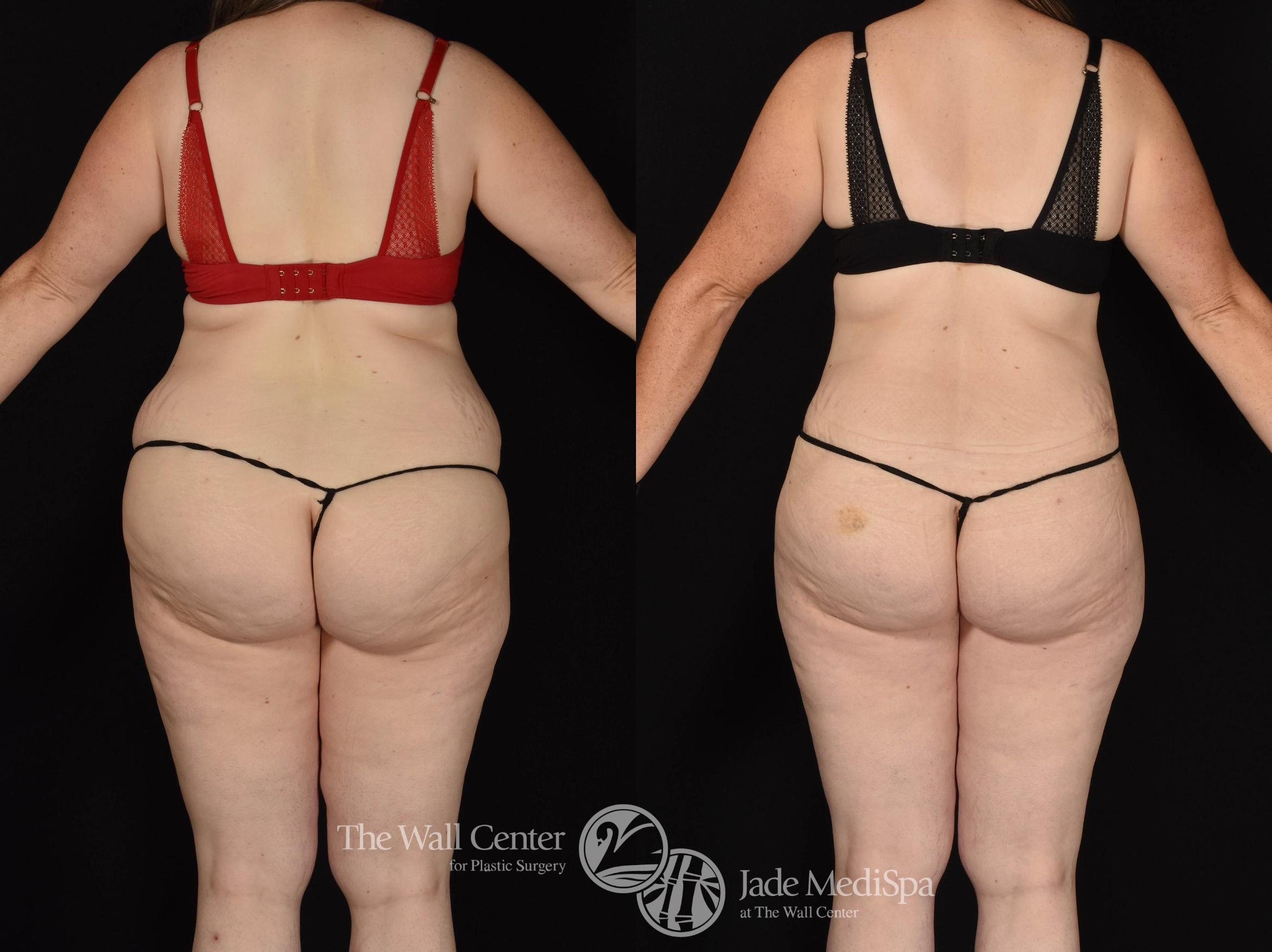Before & After Tummy Tuck Case 799 VIEW #4 View in Shreveport, LA