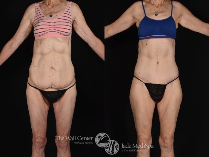 Abdominoplasty Front Photo, Shreveport, LA, The Wall Center for Plastic Surgery, Case 806
