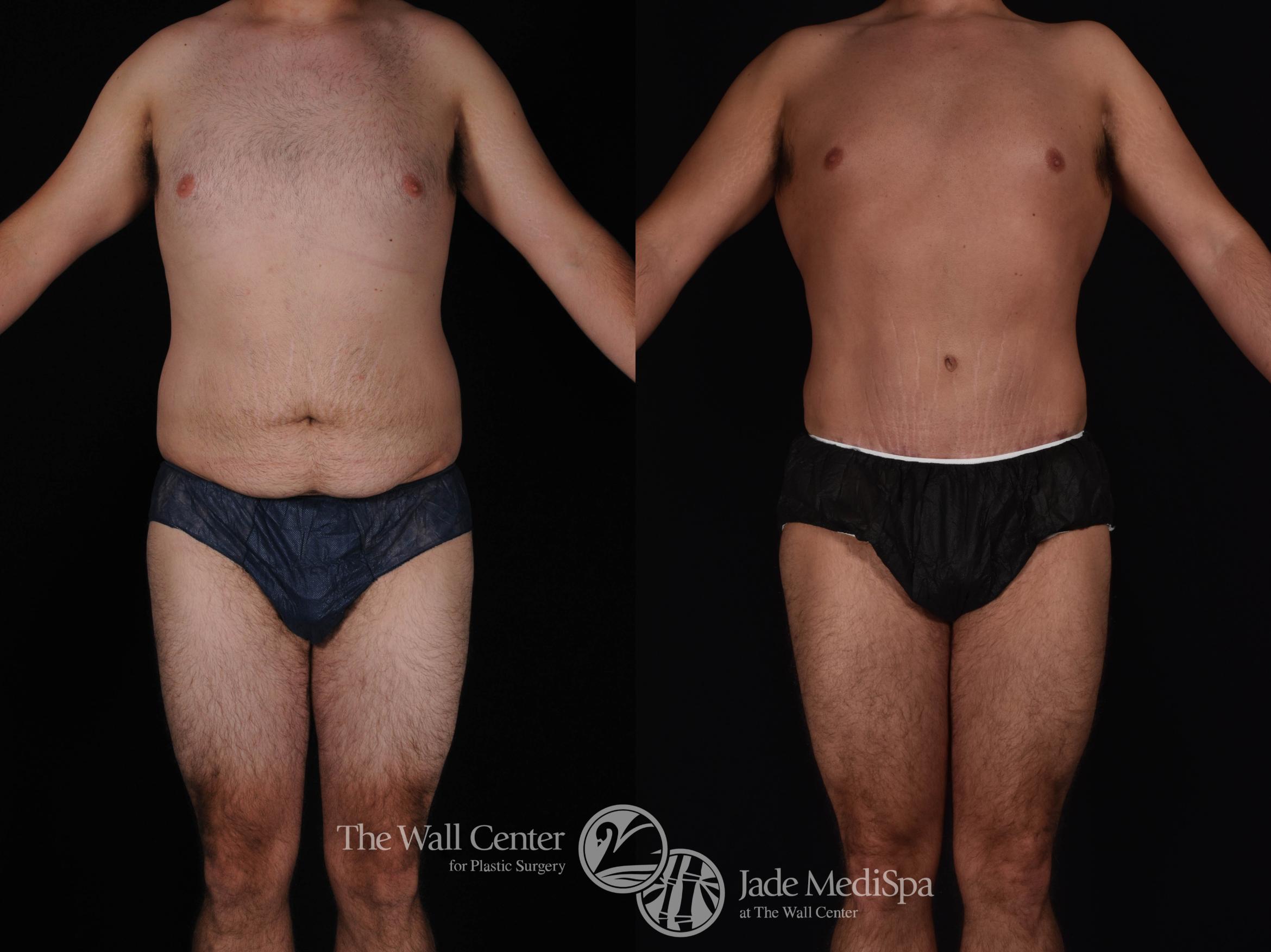Abdominoplasty with SAFELipo Front Photo, Shreveport, LA, The Wall Center for Plastic Surgery, Case 809