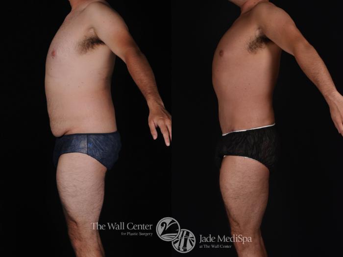 Abdominoplasty with SAFELipo Left Side Photo, Shreveport, LA, The Wall Center for Plastic Surgery, Case 809