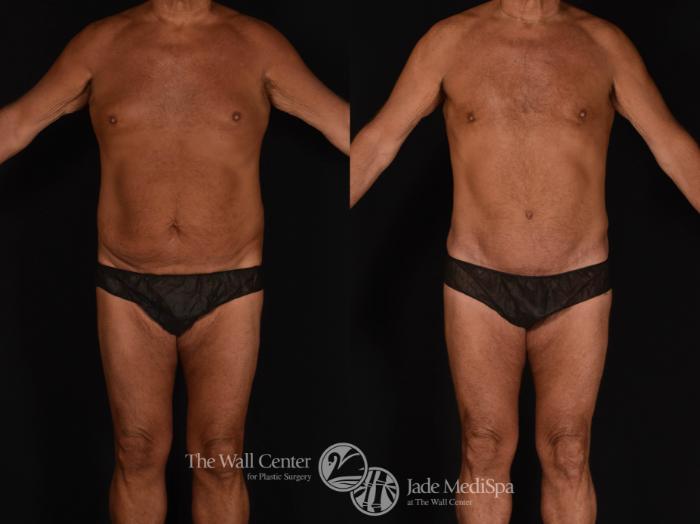 Abdominoplasty Front Photo, Shreveport, LA, The Wall Center for Plastic Surgery, Case 819