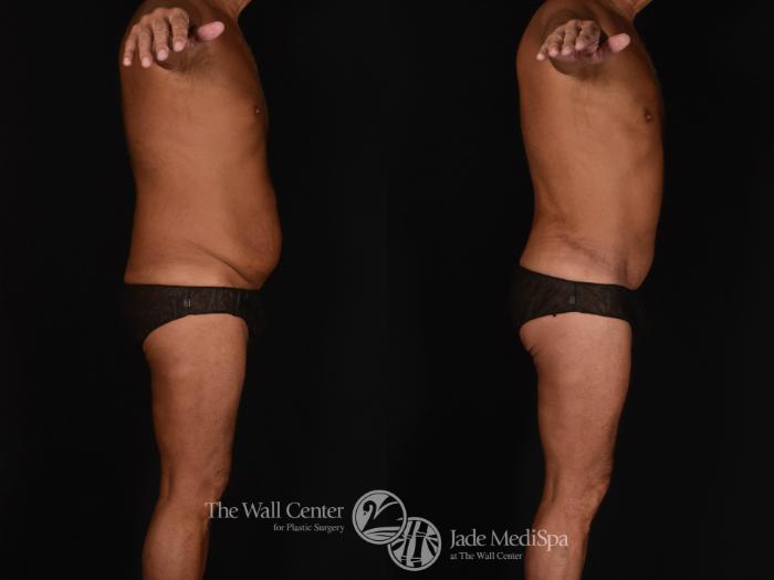 Abdominoplasty Right Side Photo, Shreveport, LA, The Wall Center for Plastic Surgery, Case 819