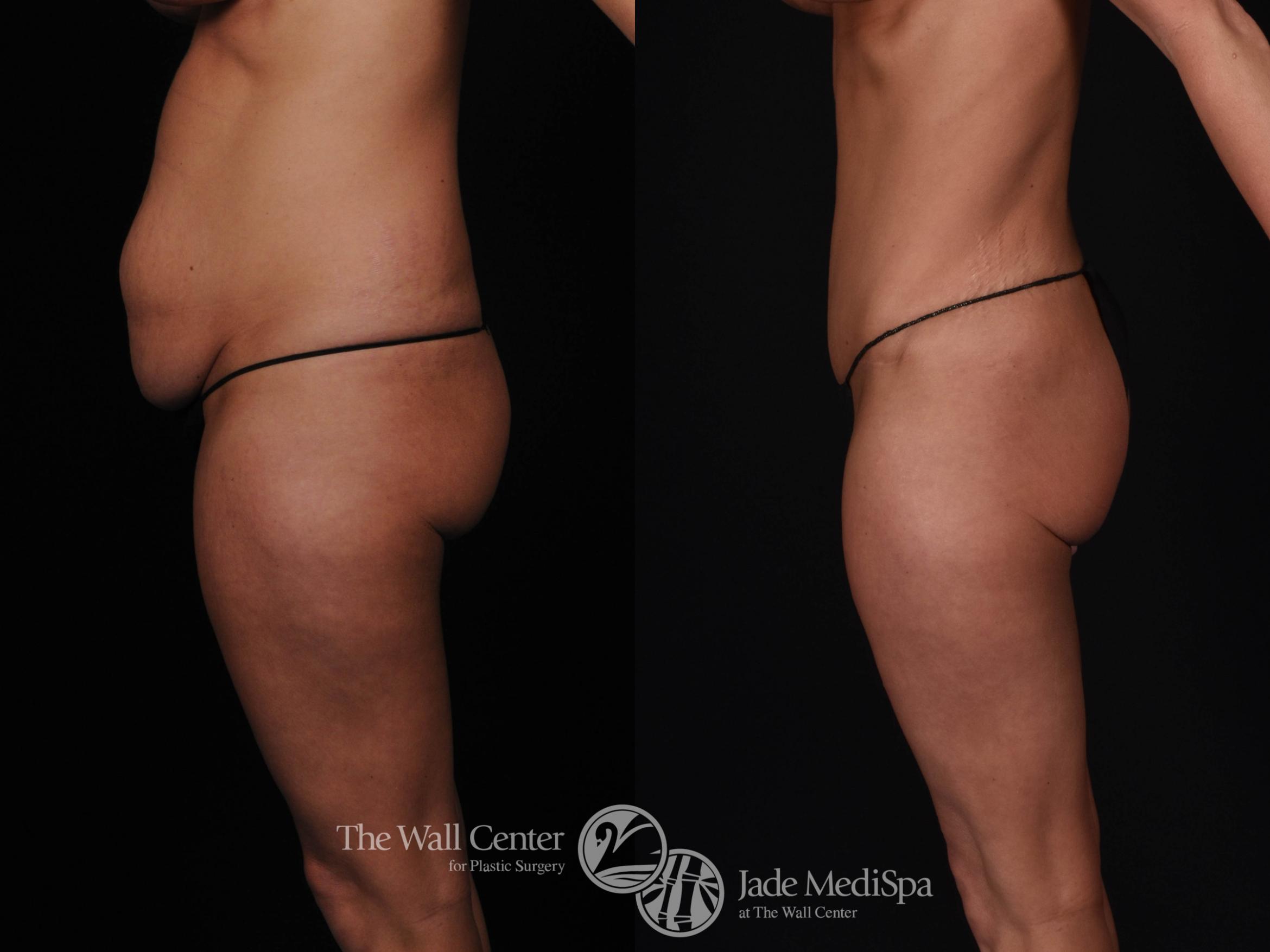 Abdominoplasty Left Side Photo, Shreveport, LA, The Wall Center for Plastic Surgery, Case 822