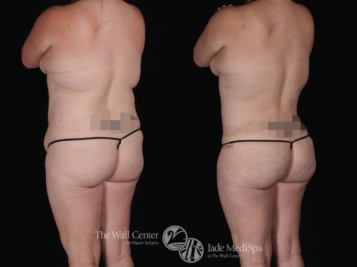 Abdominoplasty Back Left Oblique Photo, Shreveport, LA, The Wall Center for Plastic Surgery, Case 827