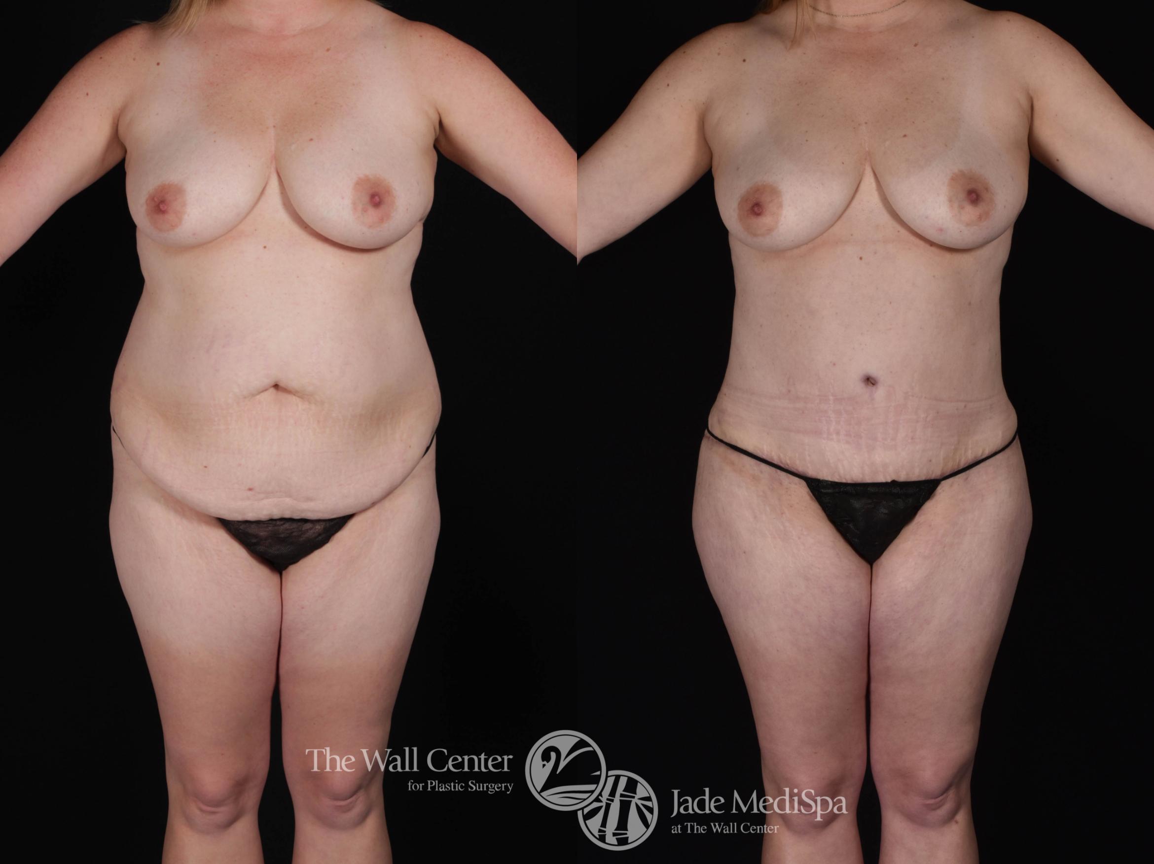 Abdominoplasty Front Photo, Shreveport, LA, The Wall Center for Plastic Surgery, Case 827